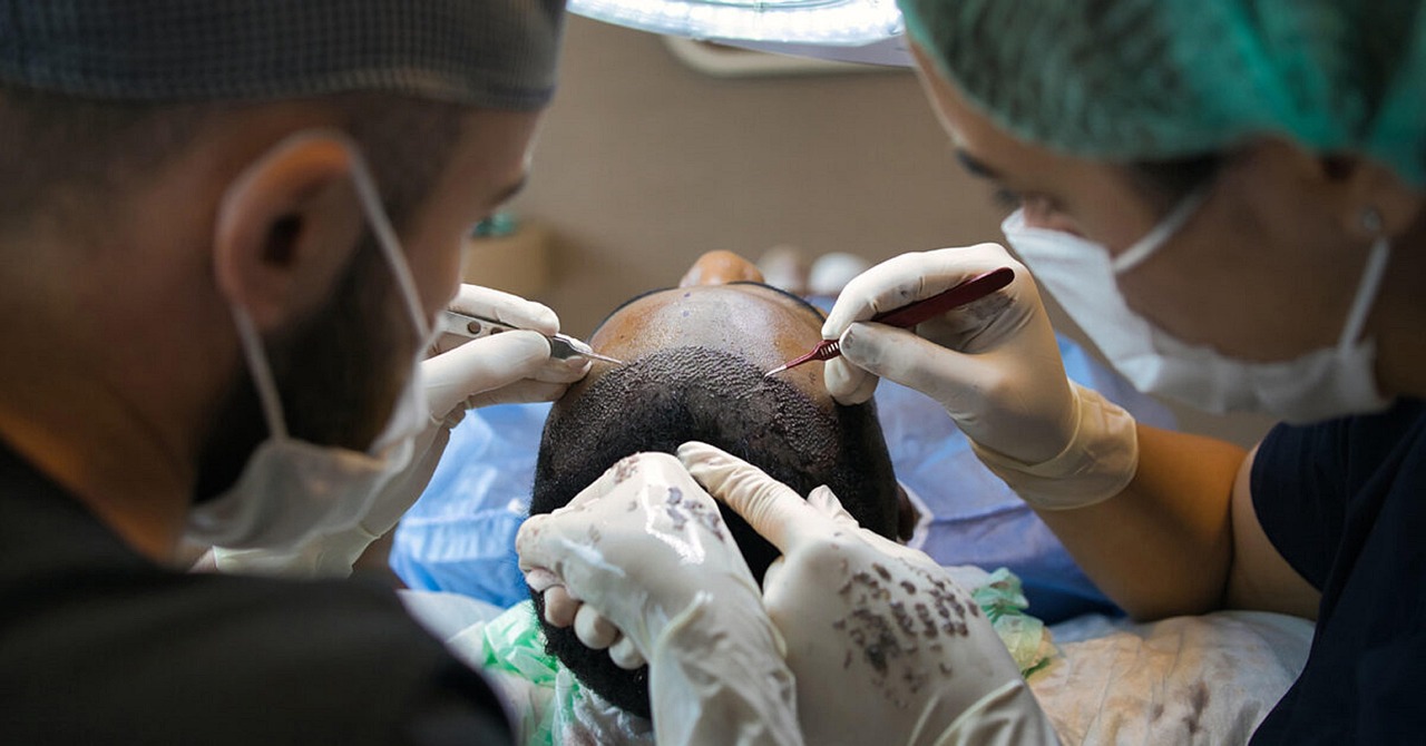 Alopecia Treatment